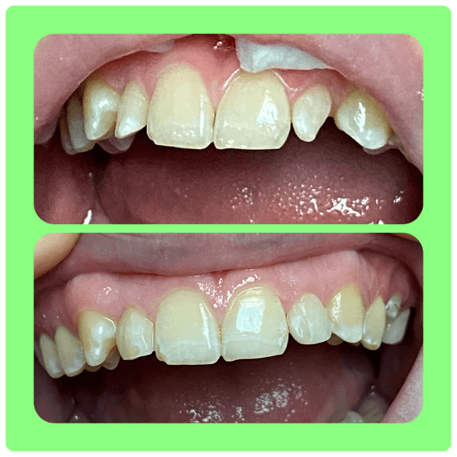 composite before and after