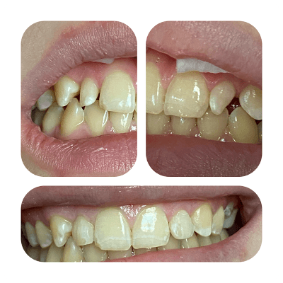 composite before and after